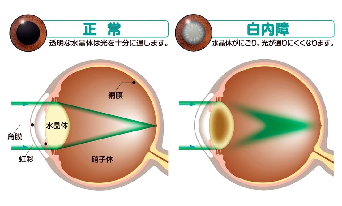 白内障の見え方