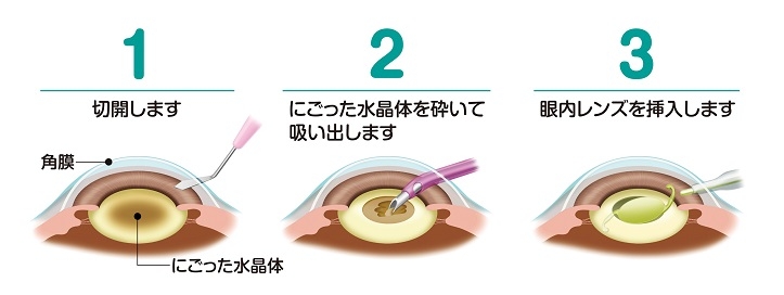 白内障手術説明