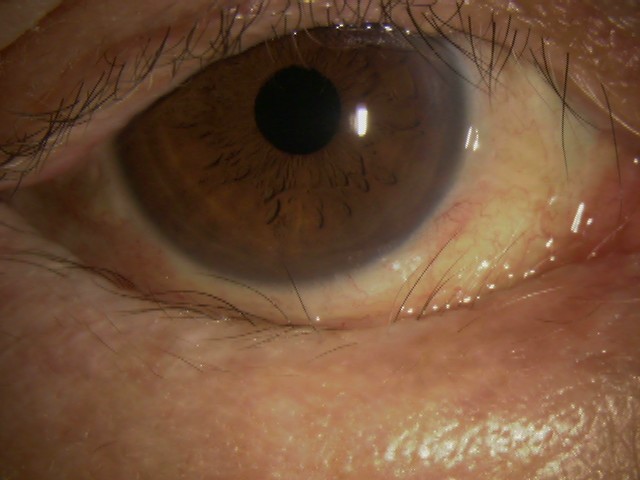 眼瞼内反症とは？